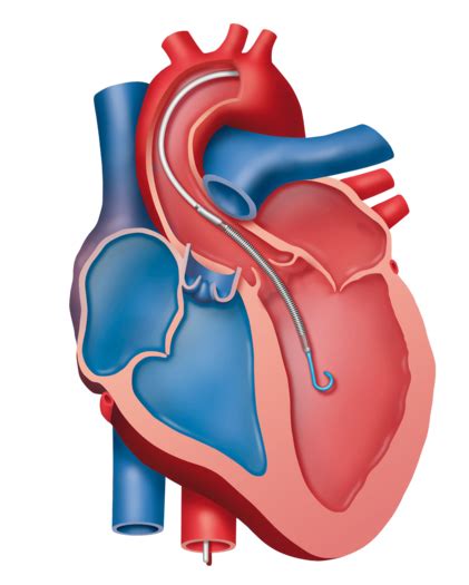 bills a screw pump heart engineering class|Continuous.